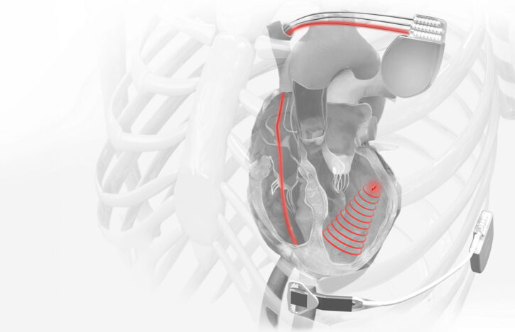 World-First FDA Approval for EBR Systems’ Leadless Cardiac Device Opens US$3.6bn Market
